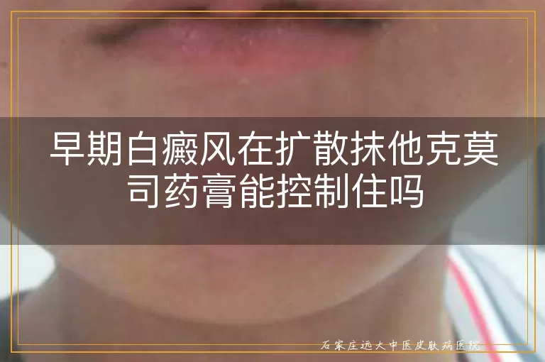 早期白癜风在扩散抹他克莫司药膏能控制住吗