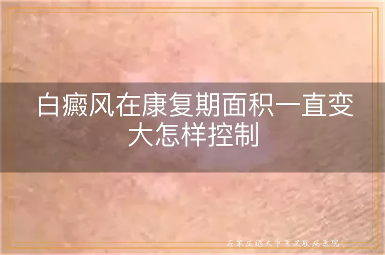 白癜风在康复期面积一直变大怎样控制