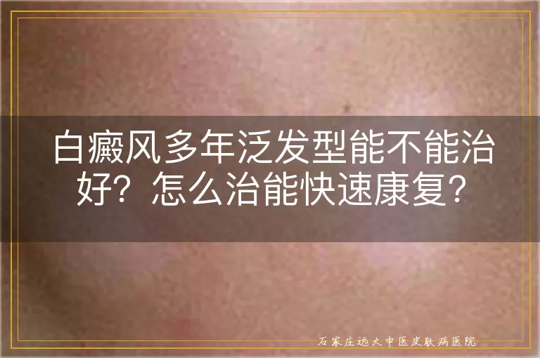 白癜风多年泛发型能不能治好？怎么治能快速康复？