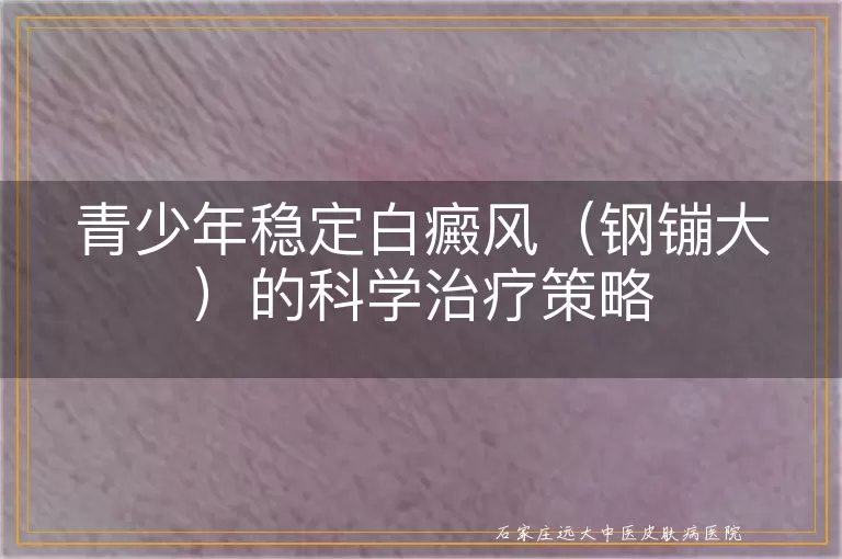 青少年稳定白癜风（钢镚大）的科学治疗策略
