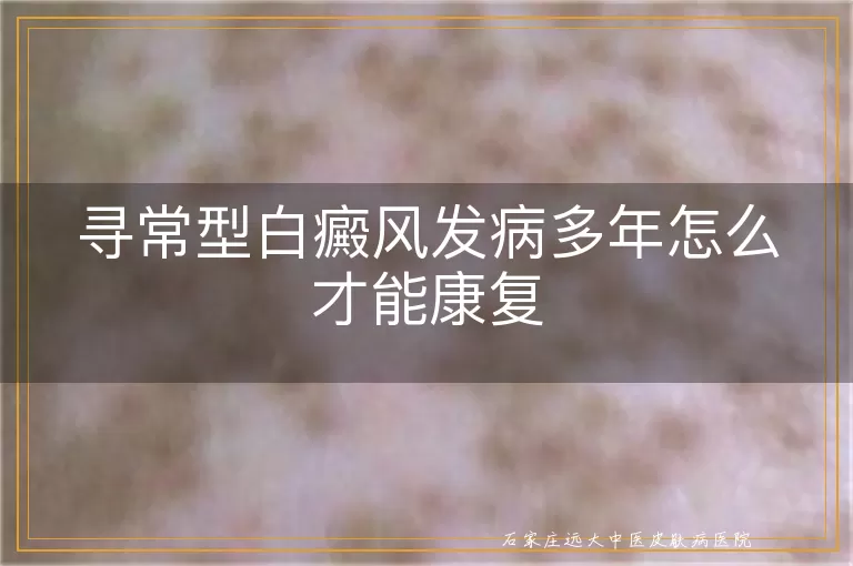 寻常型白癜风发病多年怎么才能康复