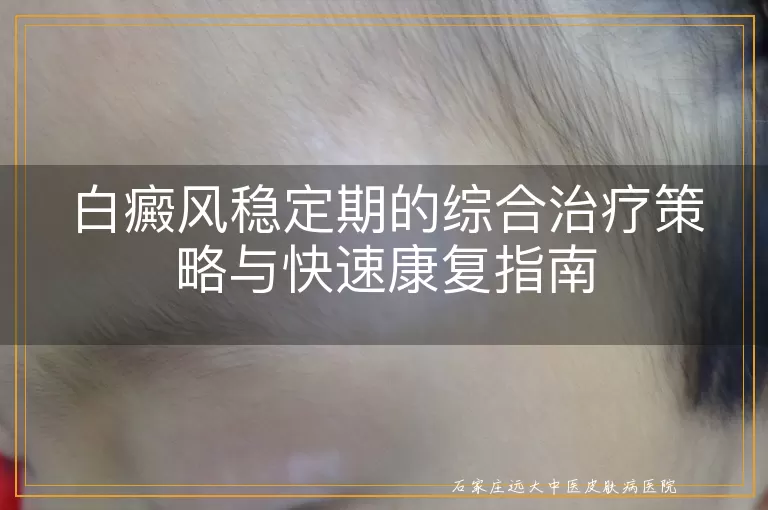 白癜风稳定期的综合治疗策略与快速康复指南