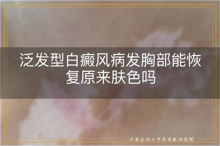 泛发型白癜风病发胸部能恢复原来肤色吗