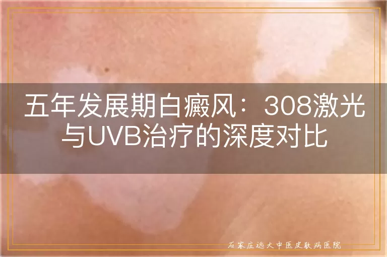 五年发展期白癜风：308激光与UVB治疗的深度对比