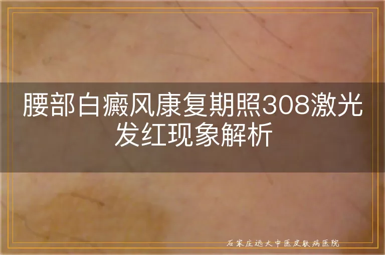 腰部白癜风康复期照308激光发红现象解析
