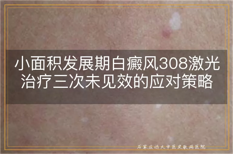 小面积发展期白癜风308激光治疗三次未见效的应对策略