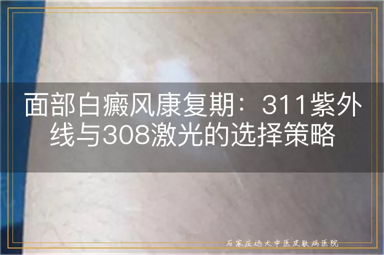 面部白癜风康复期：311紫外线与308激光的选择策略
