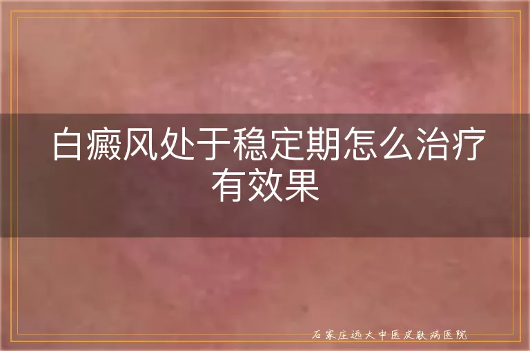 白癜风处于稳定期怎么治疗有效果