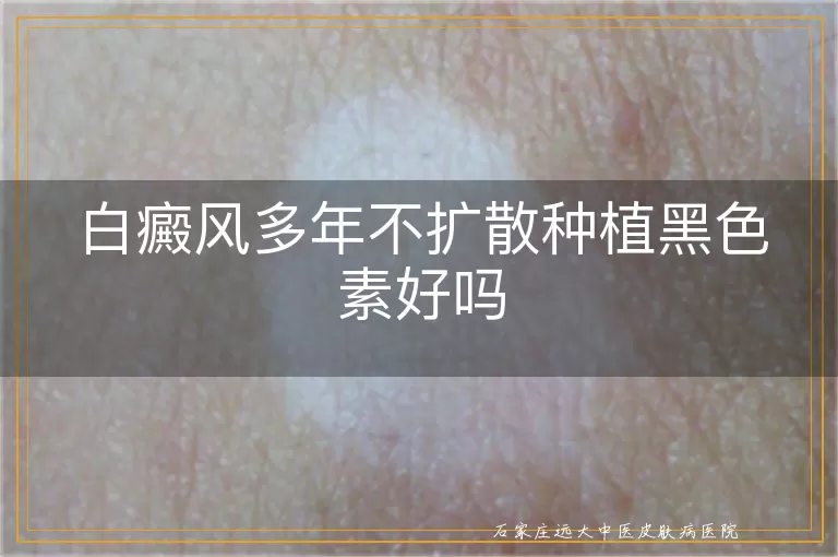 白癜风多年不扩散种植黑色素好吗
