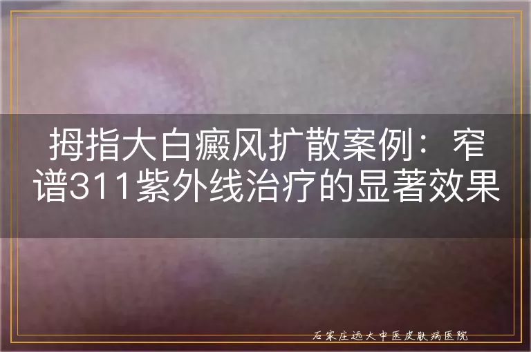 拇指大白癜风扩散案例：窄谱311紫外线治疗的显著效果