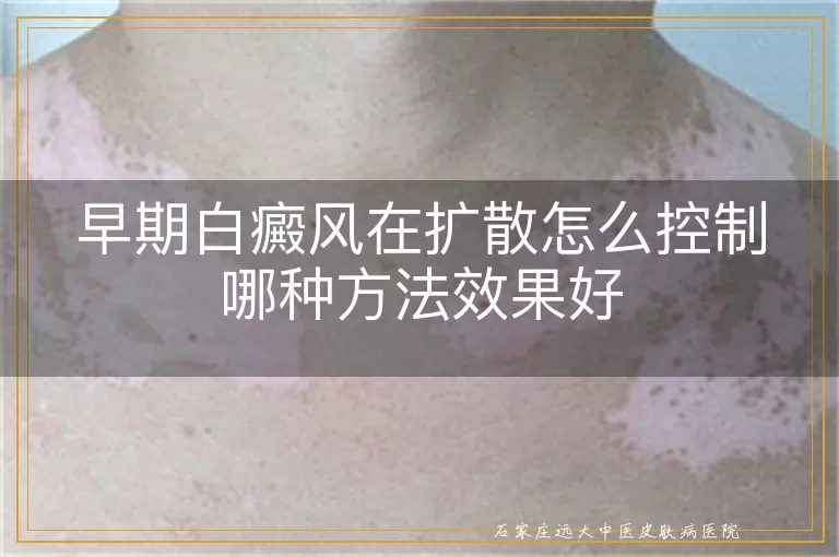 早期白癜风在扩散怎么控制哪种方法效果好