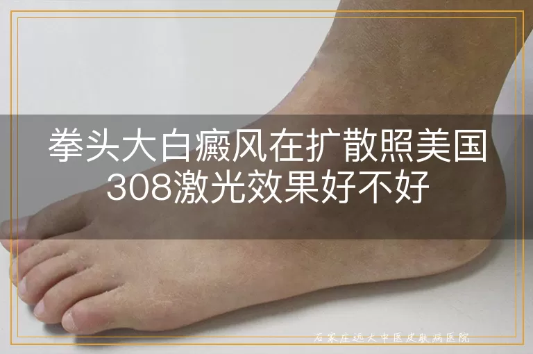 拳头大白癜风在扩散照美国308激光效果好不好