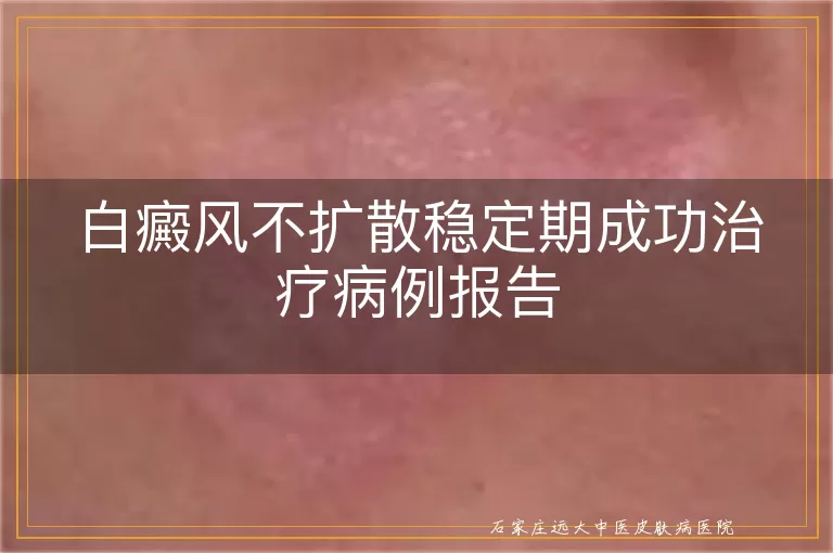 白癜风不扩散稳定期成功治疗病例报告