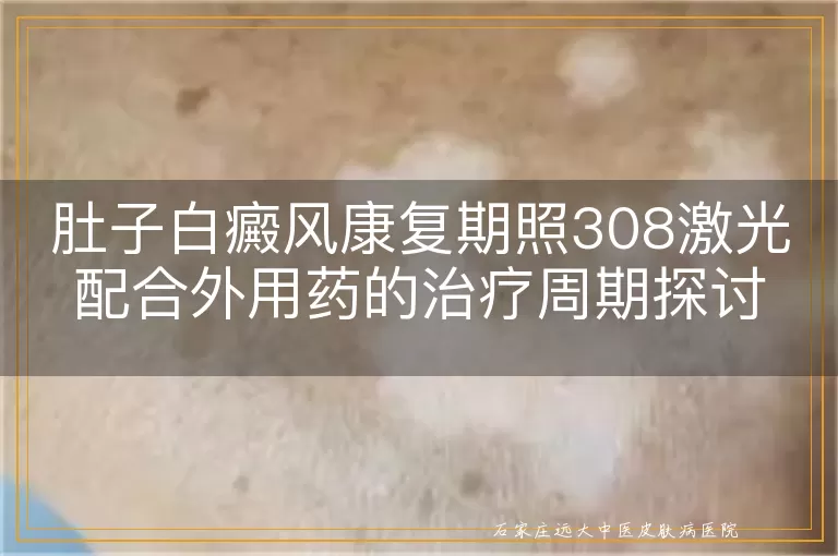 肚子白癜风康复期照308激光配合外用药的治疗周期探讨