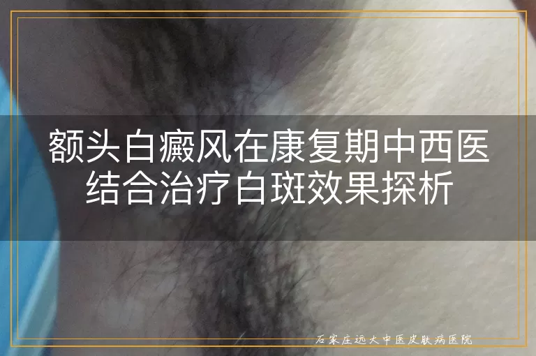 额头白癜风在康复期中西医结合治疗白斑效果探析
