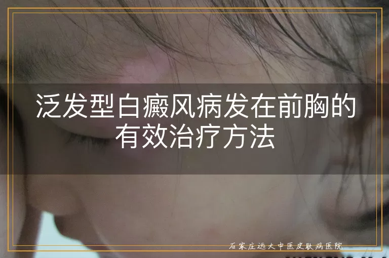 泛发型白癜风病发在前胸的有效治疗方法