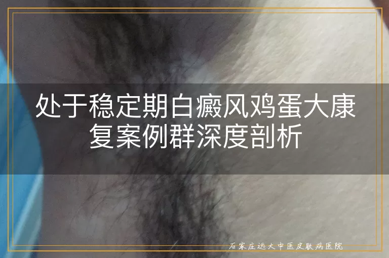 处于稳定期白癜风鸡蛋大康复案例群深度剖析