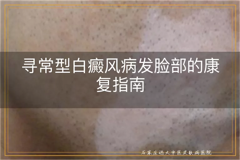 寻常型白癜风病发脸部的康复指南