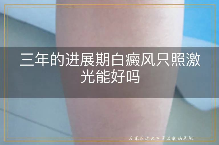 三年的进展期白癜风只照激光能好吗