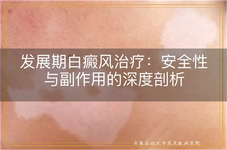 发展期白癜风治疗：安全性与副作用的深度剖析