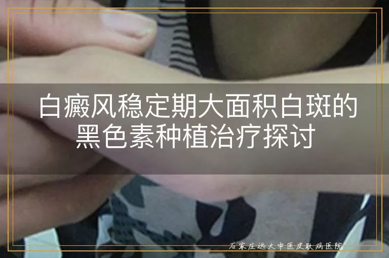 白癜风稳定期大面积白斑的黑色素种植治疗探讨