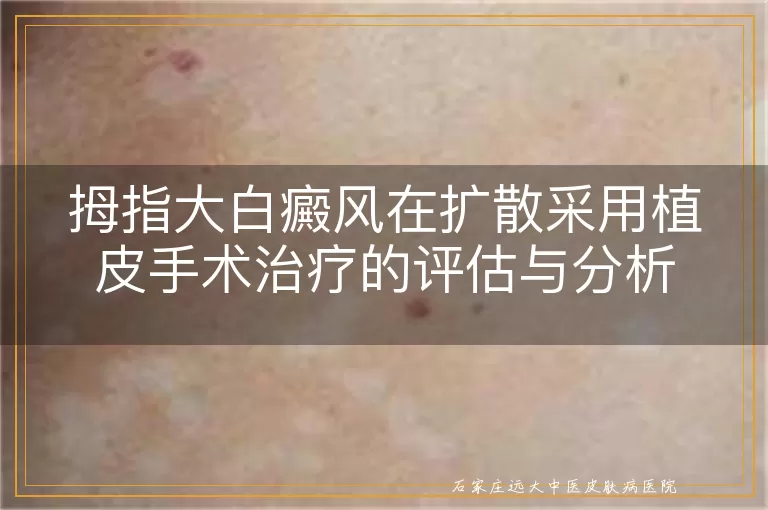 拇指大白癜风在扩散采用植皮手术治疗的评估与分析