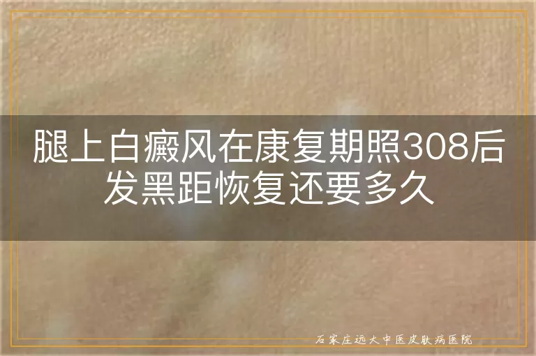腿上白癜风在康复期照308后发黑距恢复还要多久