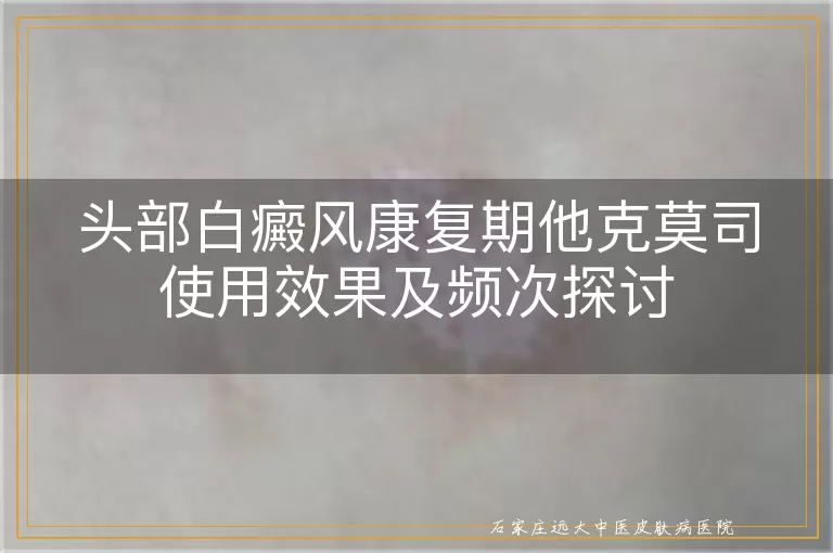 头部白癜风康复期他克莫司使用效果及频次探讨