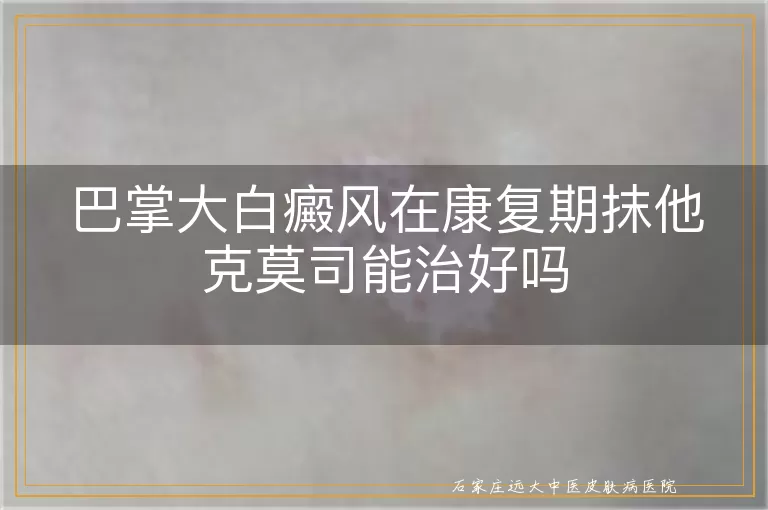 巴掌大白癜风在康复期抹他克莫司能治好吗