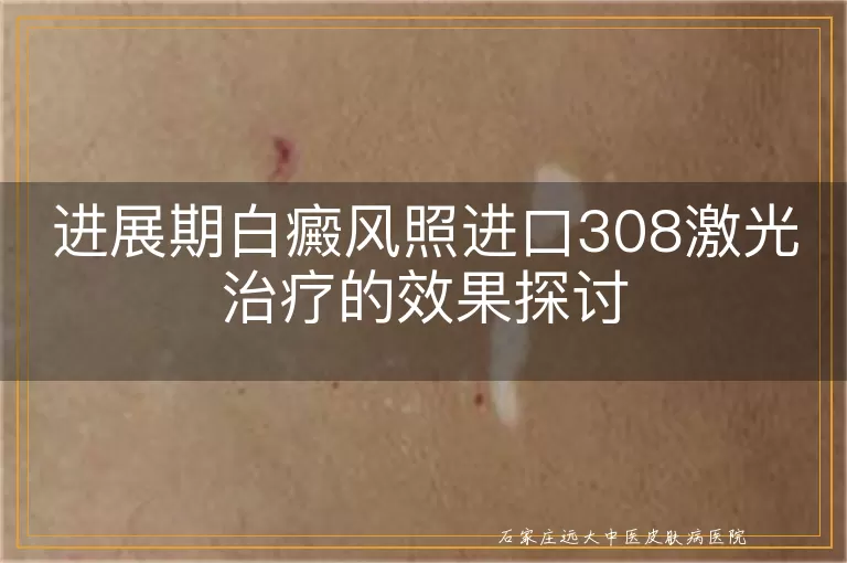 进展期白癜风照进口308激光治疗的效果探讨