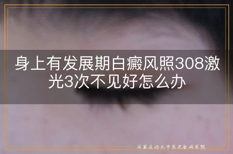 身上有发展期白癜风照308激光3次不见好怎么办