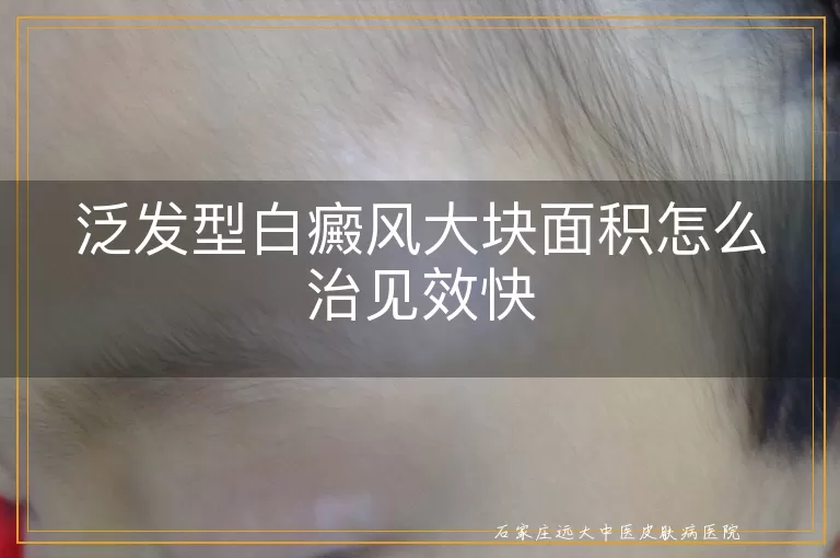 泛发型白癜风大块面积怎么治见效快