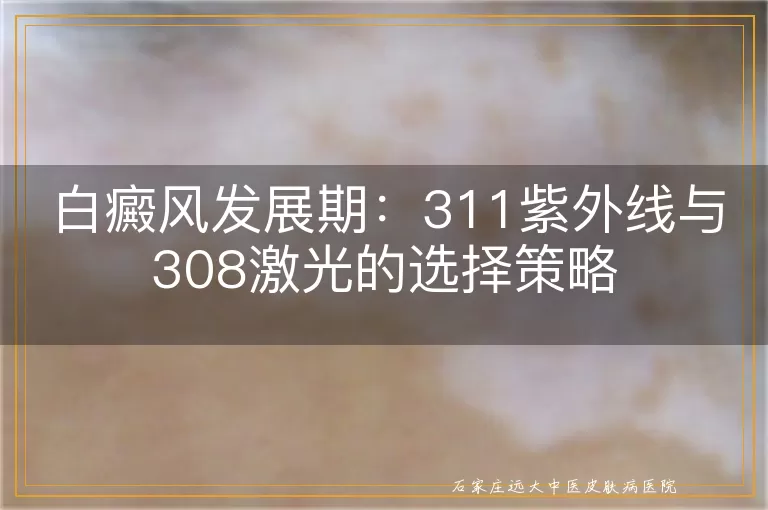 白癜风发展期：311紫外线与308激光的选择策略