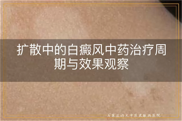 扩散中的白癜风中药治疗周期与效果观察