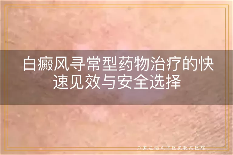 白癜风寻常型药物治疗的快速见效与安全选择