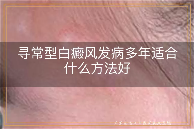 寻常型白癜风发病多年适合什么方法好