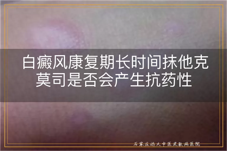 白癜风康复期长时间抹他克莫司是否会产生抗药性