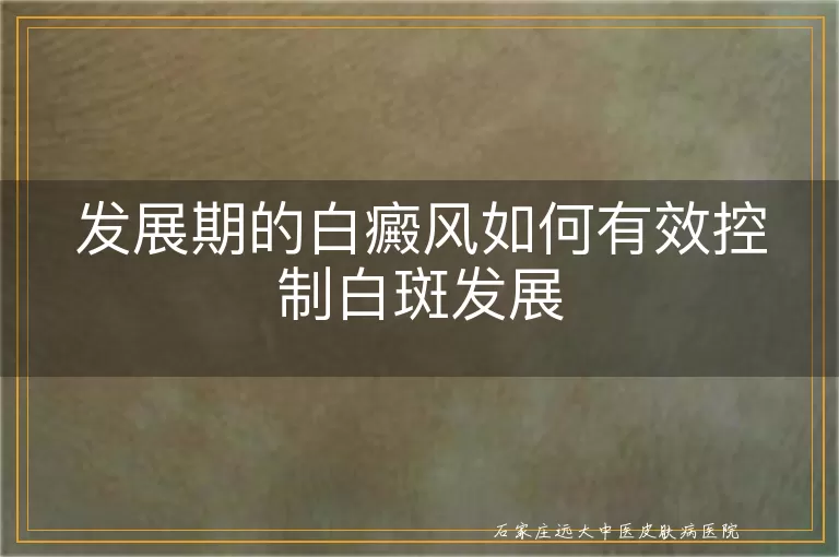 发展期的白癜风如何有效控制白斑发展