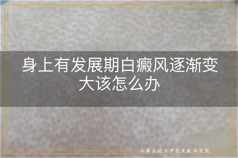 身上有发展期白癜风逐渐变大该怎么办