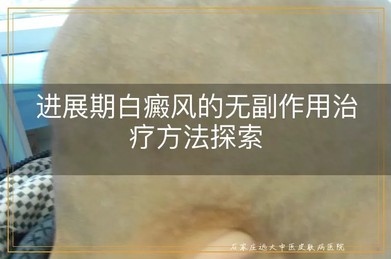 进展期白癜风的无副作用治疗方法探索