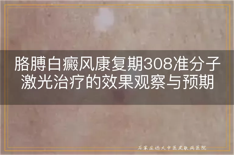 胳膊白癜风康复期308准分子激光治疗的效果观察与预期