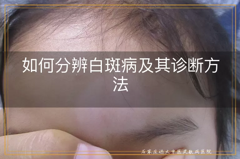 如何分辨白斑病及其诊断方法
