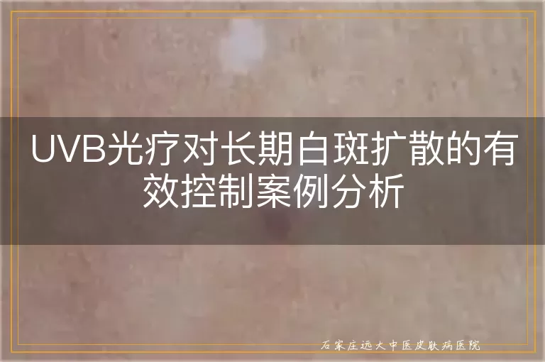 UVB光疗对长期白斑扩散的有效控制案例分析