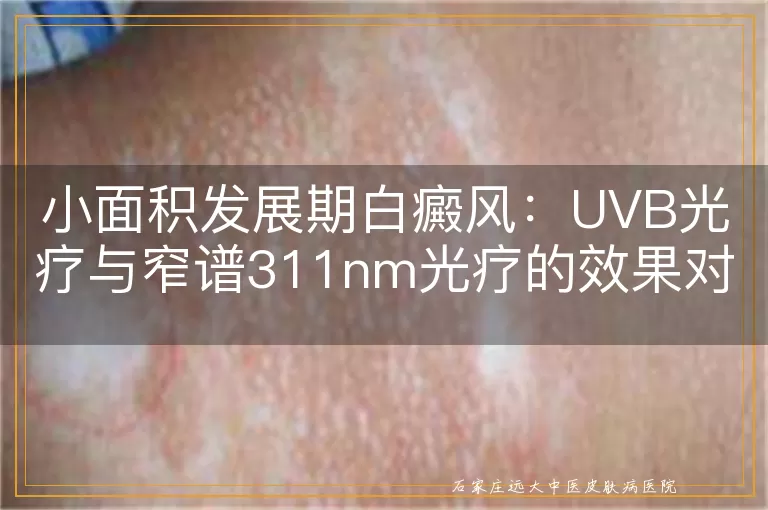 小面积发展期白癜风：UVB光疗与窄谱311nm光疗的效果对比