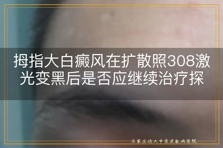拇指大白癜风在扩散照308激光变黑后是否应继续治疗探讨