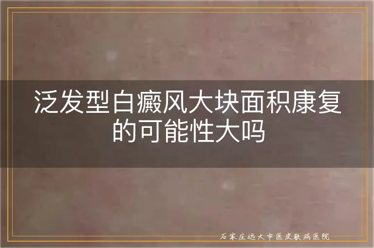 泛发型白癜风大块面积康复的可能性大吗