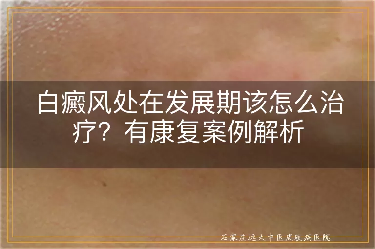 白癜风处在发展期该怎么治疗？有康复案例解析