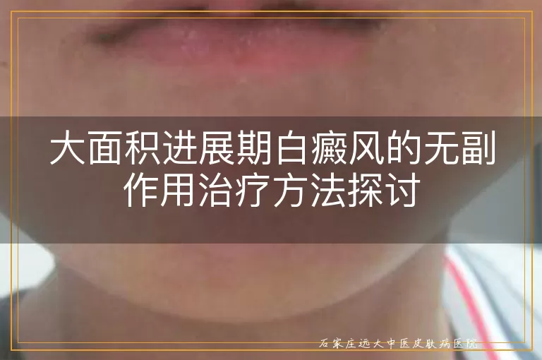 大面积进展期白癜风的无副作用治疗方法探讨