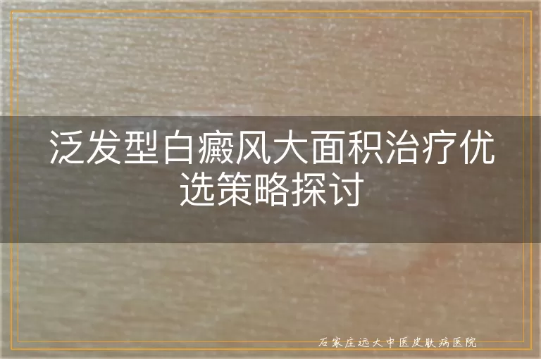 泛发型白癜风大面积治疗优选策略探讨