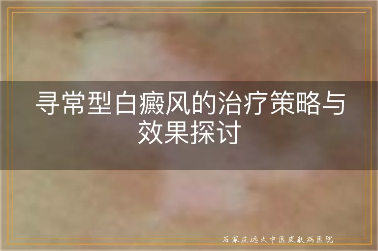 寻常型白癜风的治疗策略与效果探讨